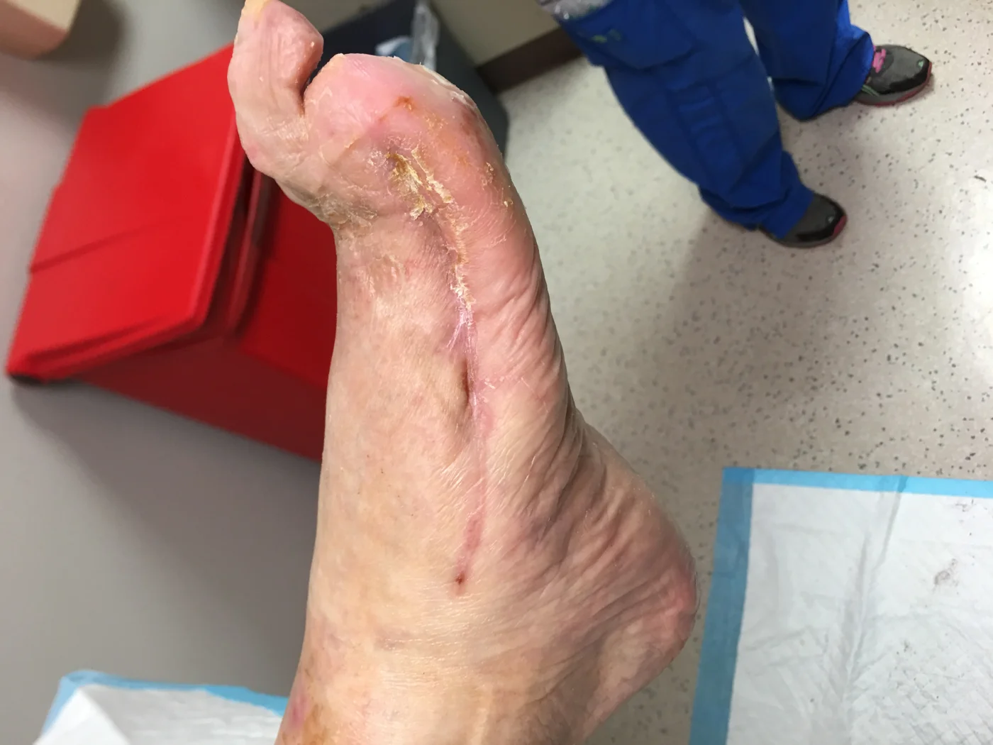 Surgical wound healed